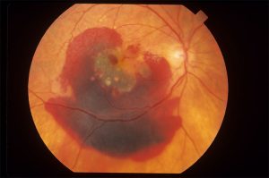 xR’s Emerging New Therapy to Treat Wet Macular Degeneration Non-Invasively Showing Unprecedented Results